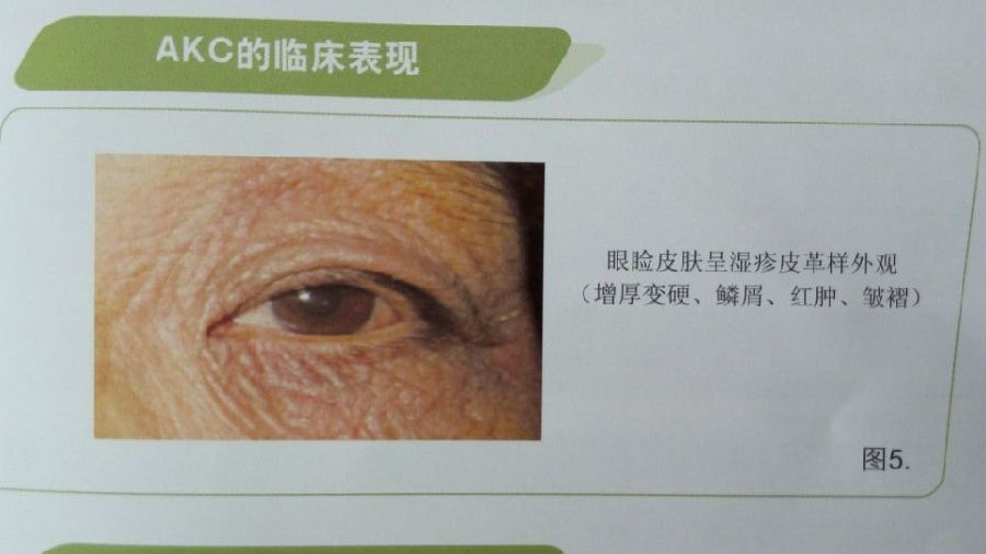 各型过敏性结膜炎特点