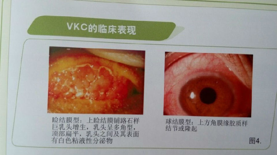各型过敏性结膜炎特点