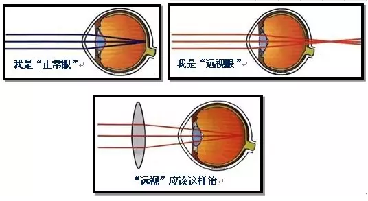 这么多年,你可能误会了"远视"-蕲春眼科医院_蕲春治疗近视--蕲春同和